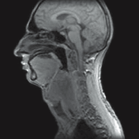 МРТ лимфоузлов шеи снимок